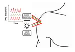 DOVE: Noninvasive Shoulder-based Opioid Overdose Detection Device